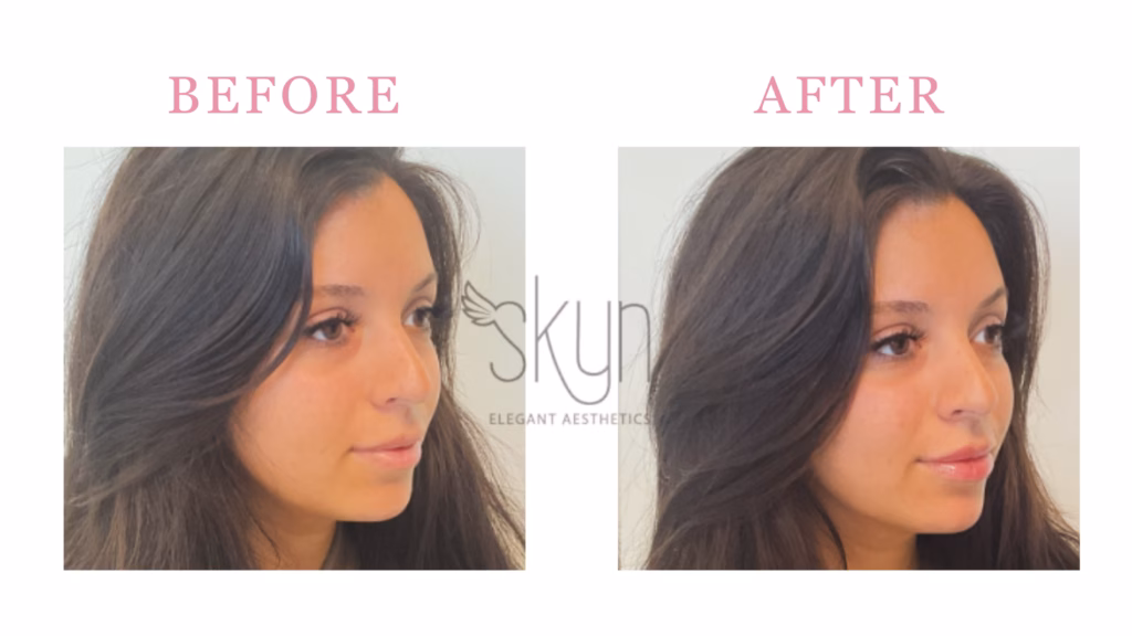 dermal fillers Before and After Facial BAlancing Results In Huntersville NC