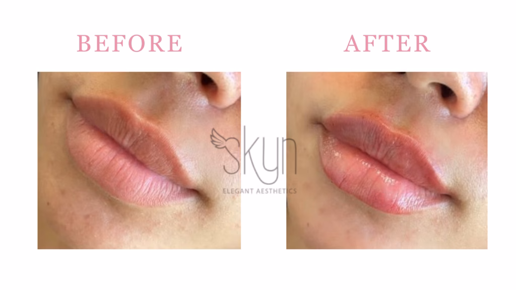Lip Filler Results In Huntersville NC Before and After Photos