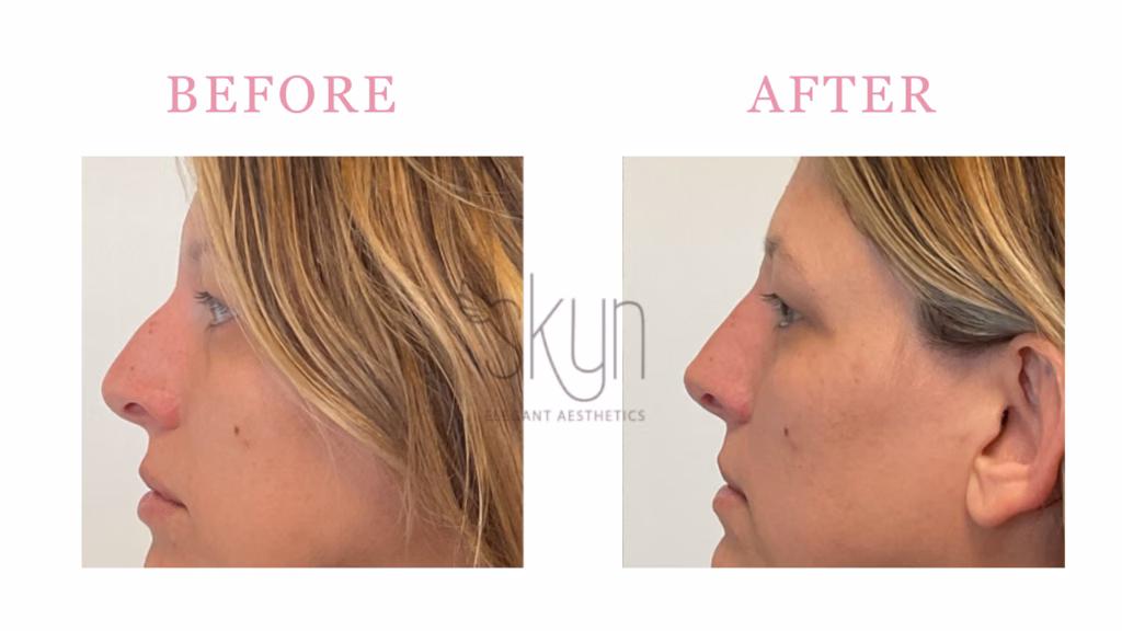 Liquid Rhinoplasty Results for a patien at Skyn Elegant Aesthetics In huntersville nc